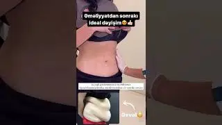 Abdominoplastika #keşfet #youtubeshorts #plastikcerrah