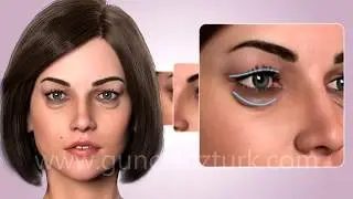 Alt - Üst Göz Kapağı Estetiği Ameliyatı (Blefaroplasti) Nasıl Yapılır? Doç.Dr. Güncel Öztürk - 