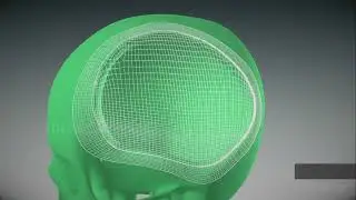 3D implant yordamida kranioplastika qilish. Краниопластика. Cranioplasty.