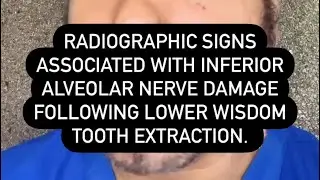 Radiological Prediction of Inferior Alveolar Nerve Injury During Lower 3rd Molar Extraction 🌟
