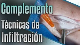 Complemento técnicas de infiltración