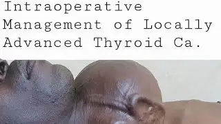Intraoperative Management of Locally Advanced Thyroid Ca. Part 3