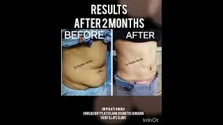 ULTRA HIGH DEFINITION LIPOSUCTION WITH TUMMY TUCK SURGERY RESULTS 😍👏👌🤩