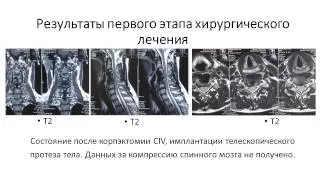 Первый опыт применения методики задней фиксации ШОП