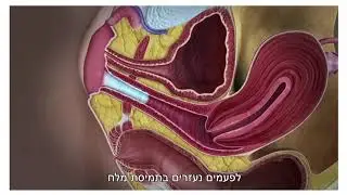 אולטרסאונד נרתיקי