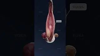 What turns a Bartholin cyst into a painful abscess? Study gynecology in 3D with VOKA