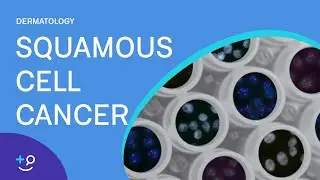 Squamous Cell Cancer [Dermatology]