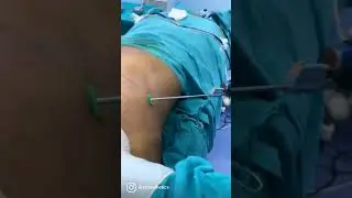 Gynecomastia Surgery | Male Breast Reduction 