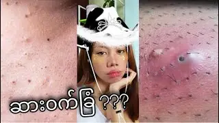 ဆားဝက်ခြံ ??? What is Blackhead ? #Skincare