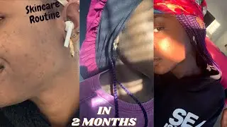 TREUSKIN CARE | HOW I CLEARED MY ACNE AND HYPERPIGMENTATION | FT TREYTAYLOR PT 2