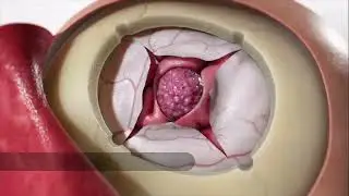 Parasagittal meningioma