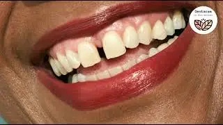 Gap in Front Teeth treatment in hindi |How to do DIASTEMA Closure |How to fix Teeth Gap