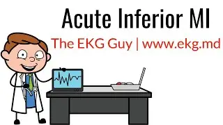 Acute Inferior MI on EKG / ECG l The EKG Guy - www.ekg.md