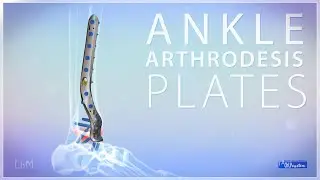 Ankle Joint Arthrodesis Plates - 7.0ChLP locked plating system