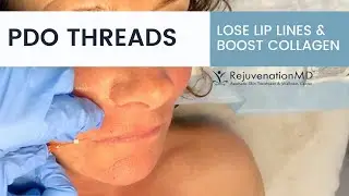PDO Lip Threads: An Effective Lip Line Removal Treatment