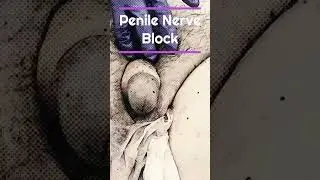 Penile Nerve Block