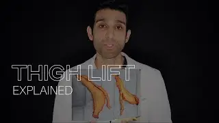 Thigh Lift