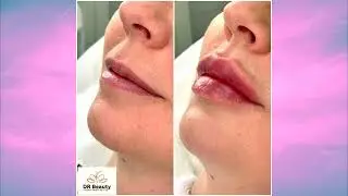 תמונות לפני ואחרי הטיפולים Dr Beauty
