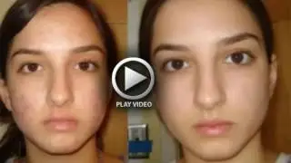 how to get rid of acne on your face - video tutorial