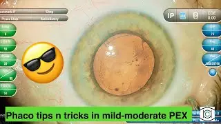 Phaco tips and tricks in mild to moderate PEX