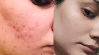 How To Remove Pimples Overnight | Acne Treatment | itshunnymakeup