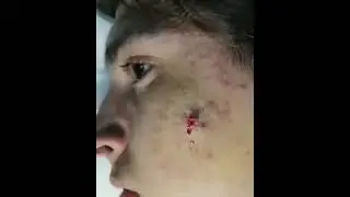 НОВОЕ ВИДЕО 2022  Прыщи давить залипательные