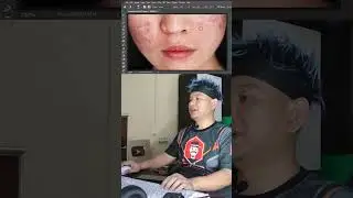 Tutorial to get rid of acne quickly 