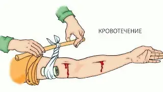 Первая помощь при артериальном кровотечении
