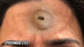 61 Pimple Pops!  Blackhead Panther!  Blackhead Extractions and Cysts