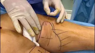Endolift interno cosce