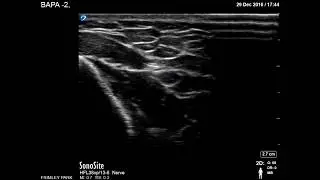 Radial nerve scanning in Spiral groove