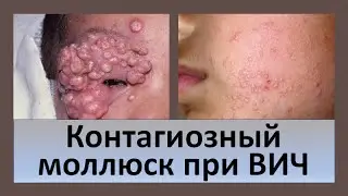 Контагиозный моллюск при ВИЧ