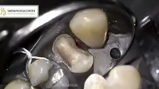 שיקום הפה בשתי פגישות