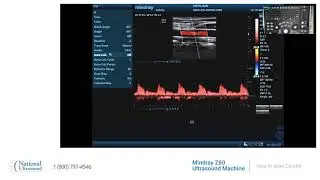 How to scan carotid on Mindray Z60