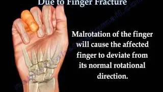 Finger Fractures Malrotation Of The Fingers - Everything You Need To Know - Dr. Nabil Ebraheim