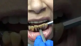 MASSIVE Calculus Buildup | Severe Gum Disease #shorts