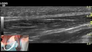 Ultrasound tutorial - Imaging of the plantar fascia
