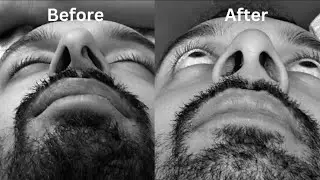 I Got a Nose Job -  Septoplasty