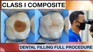 Dental Filling Full Procedure Class I Composite | General Dentist Griya RR