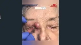 Satisfying Pimple Poping 2022 || Busty Poper
