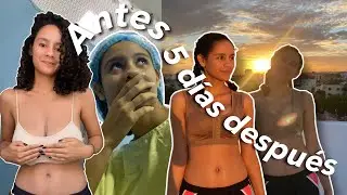 Mi Reducción de Busto - Me Operé