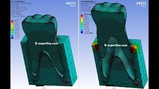 ANSYS WB Explicit Dynamics - FEA simulation of Tooth extraction simulation with gum erosion (v1)