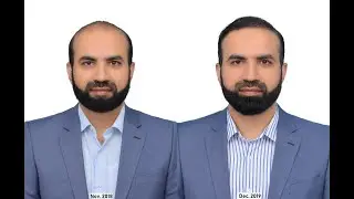 Hair Transplant, istanbul Turkey, Dr. Serkan Aygin