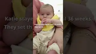 The Miracle of the 87-Day Twins