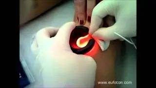 Phlebology - Reticular Veins Treated With LASEmaR 800 - Reticolari LASEmaR 800