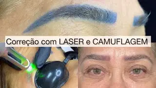 Correção com remoção a laser e camuflagem