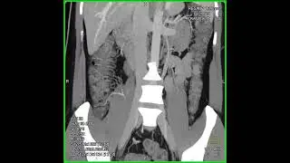 Crohn's disease 2