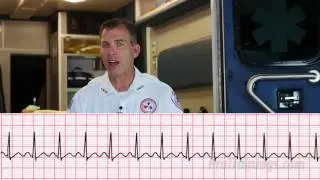 Supraventricular Tachycardia (ECG Rhythm Interpretation)