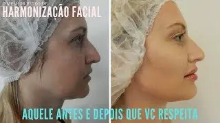 HARMONIZAÇÃO FACIAL: O MELHOR VÍDEO SOBRE DO YOUTUBE