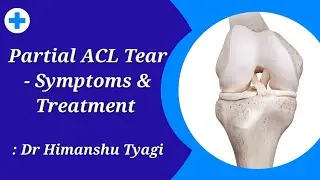 Partial ACL Tear - Symptoms & Treatment